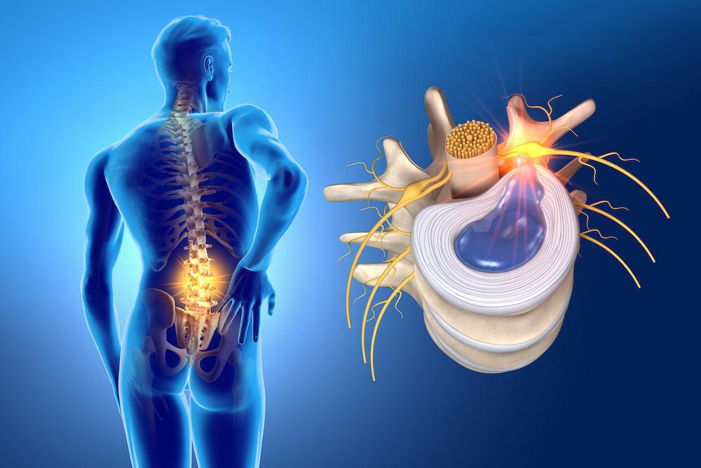 Herniated Disc - Principal Spine